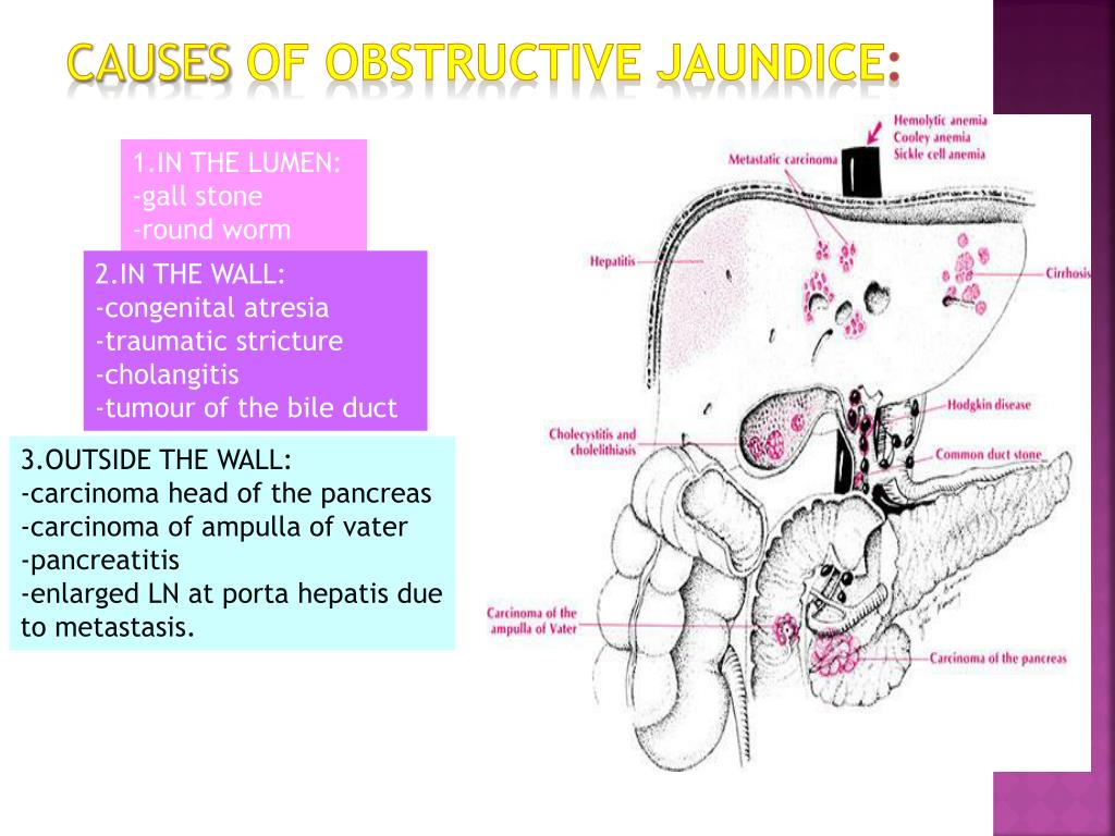 clinical presentation of obstructive jaundice