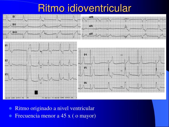 Ritmo Riva PPT - ARRITMIAS CARDIACAS PowerPoint Presentation - ID:3824403