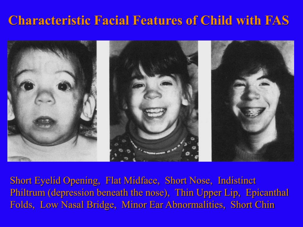 PPT - Fetal Alcohol Syndrome and Alcohol- Related Neurodevelopmental ...