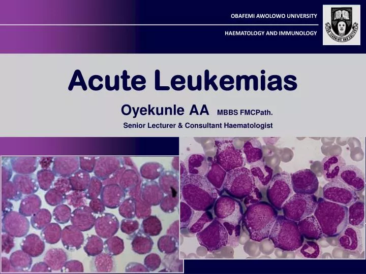 PPT Acute Leukemias PowerPoint Presentation, free download ID3841754