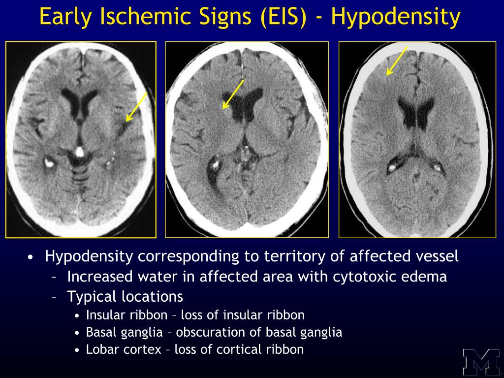 PPT Acute Stroke Imaging PowerPoint Presentation Free Download ID 