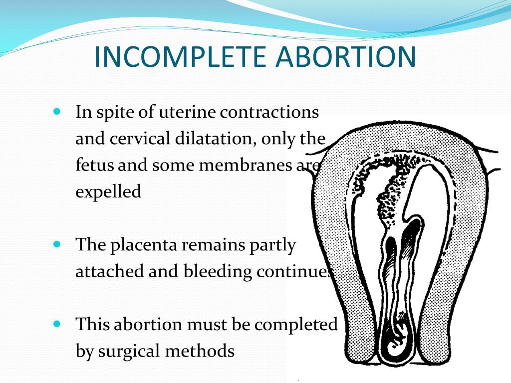 INCOMPLETE ABORTION 