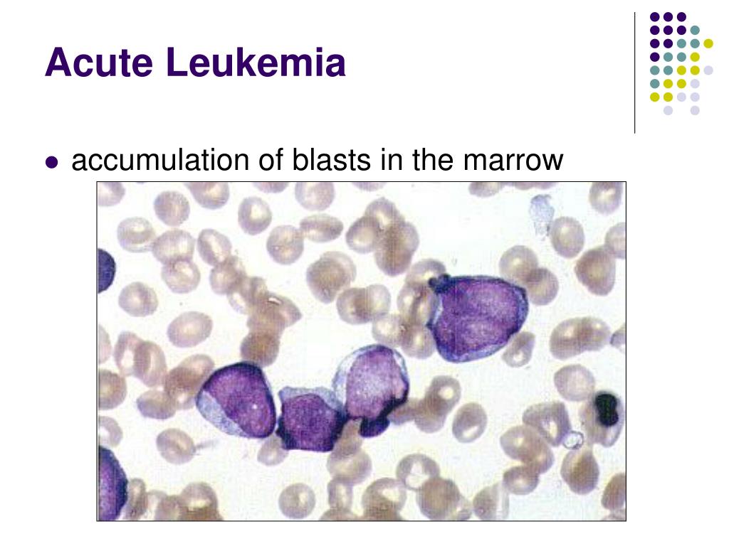 Ppt Acute Leukemias Powerpoint Presentation Free Download Id3859381