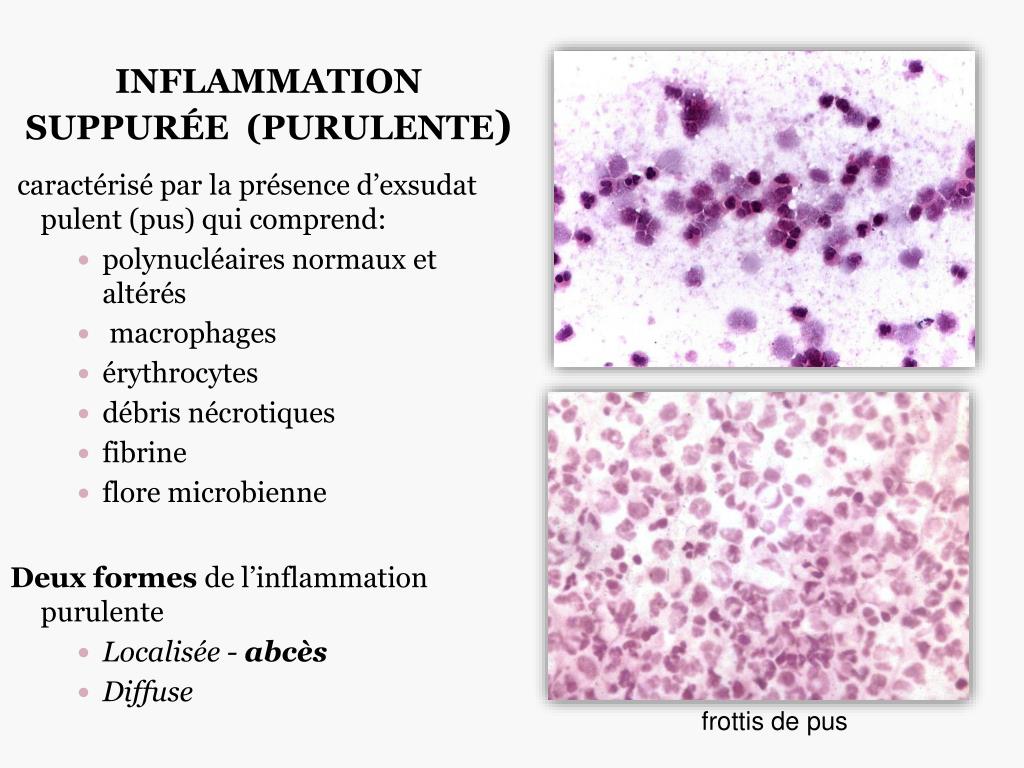 PPT - INFLAMMATION PowerPoint Presentation, free download - ID:3871379