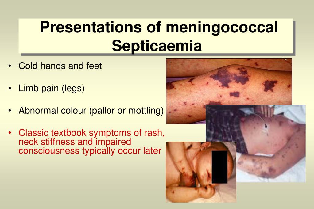 Ppt Update On Meningococcal Meningitis Powerpoint Presentation Free