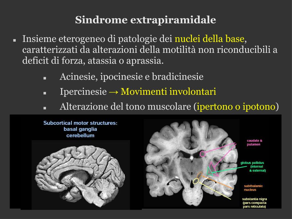 Differenza Tra Sindrome Piramidale Ed Extrapiramidale PPT - Sindromi extrapiramidali Sindrome cerebellare PowerPoint