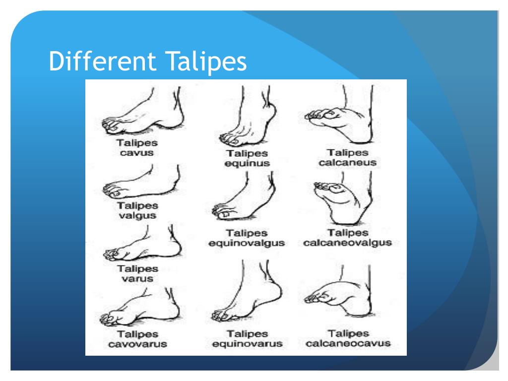 PPT Talipes Clubfoots PowerPoint Presentation Free Download ID 
