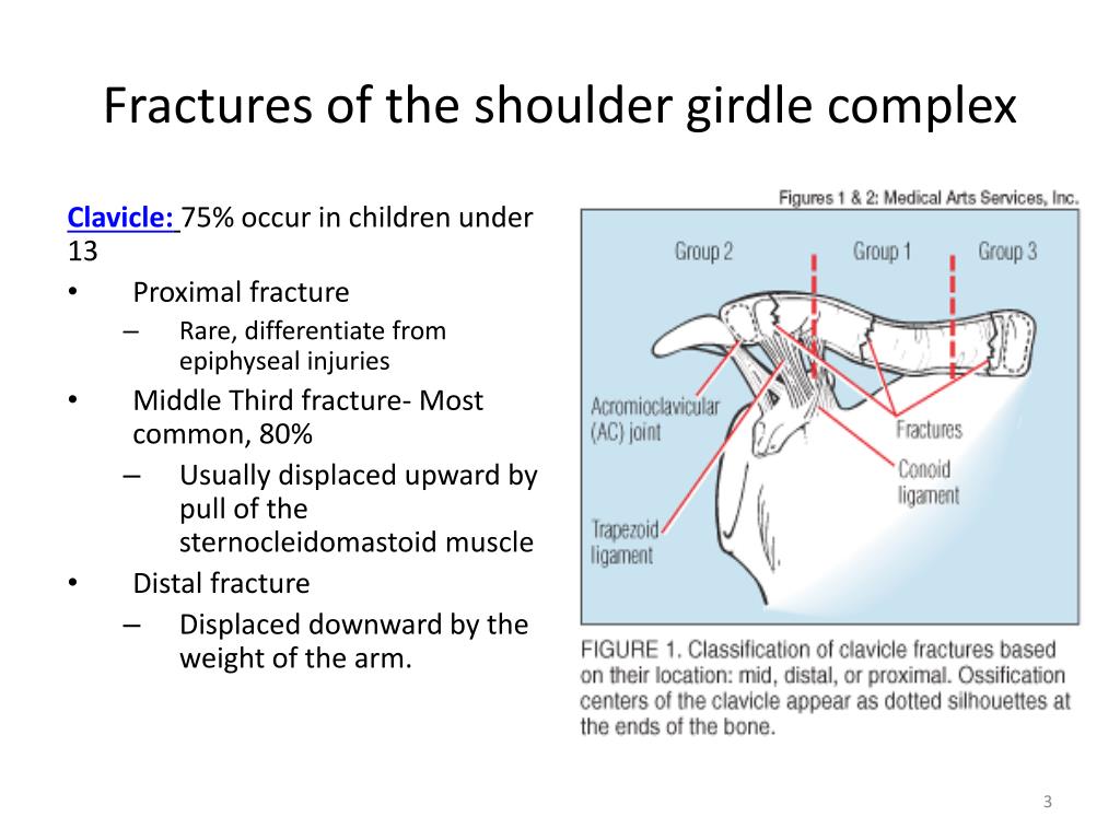 Pectoral Girdle Fractures