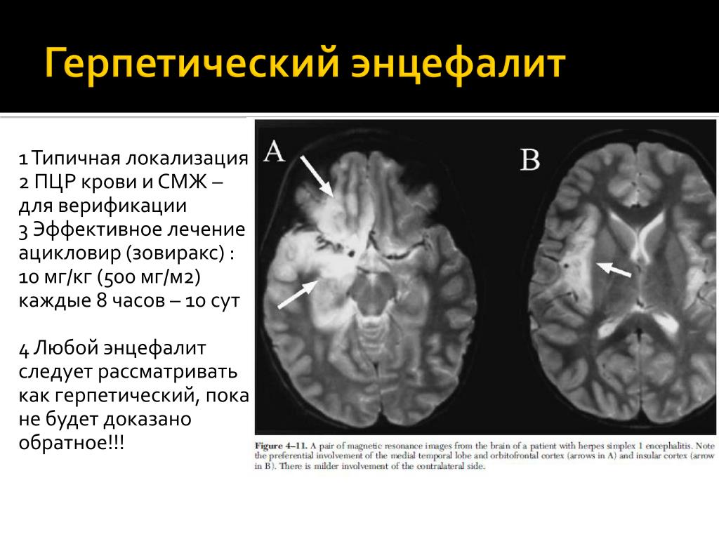 Изменения головного мозга у новорожденного. Гриппозный энцефалит мрт. Герпетический энцефалит кт головного мозга. Герпетический энцефалит поражение головного мозга.