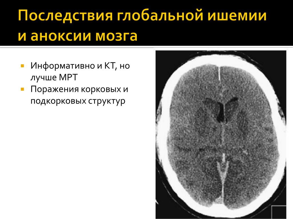 Последствия поражения мозга. Ишемическая аноксия. Аноксическое поражение мозга. Стадии ишемии головного мозга на кт.