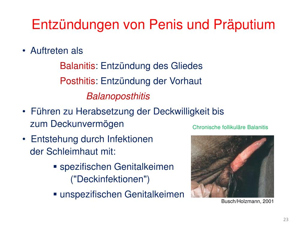 Penis entzündung Balanitis (Eichelentzündung):