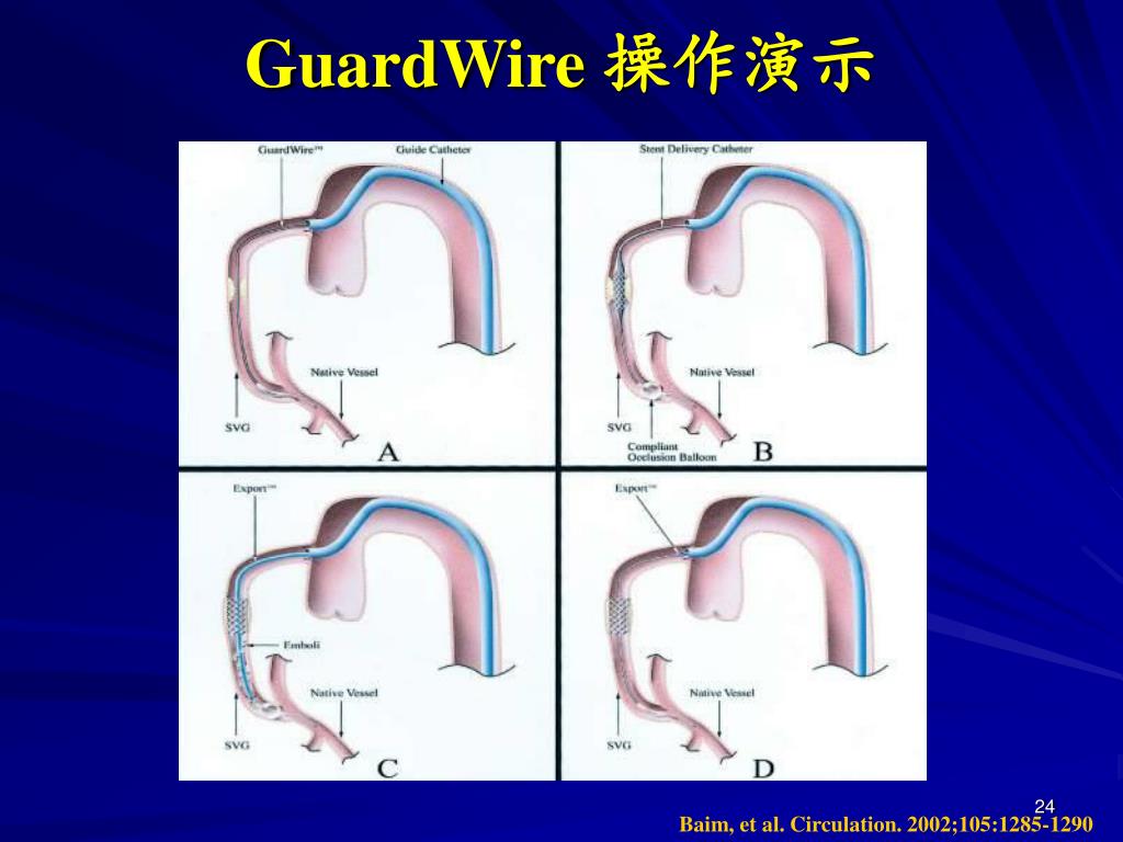 Guardwire PPT - CABG 术后再次血运重建 PowerPoint Presentation, free download - ID:3887095