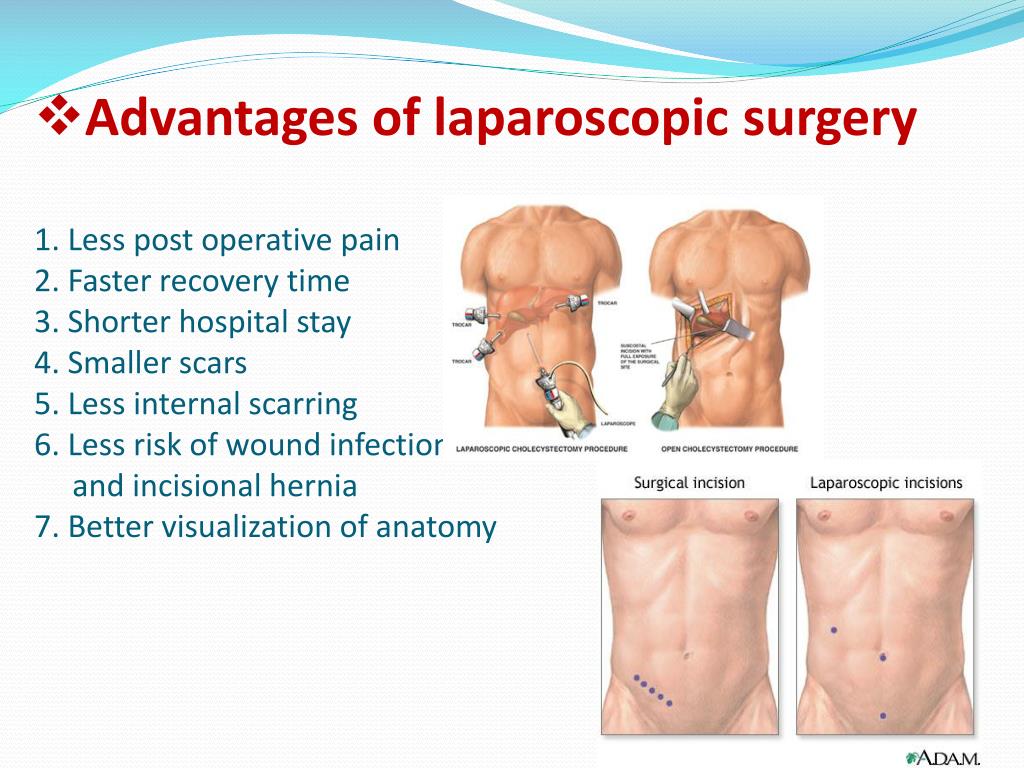PPT Basic Principles Of LAPAROSCOPIC SURGERY PowerPoint Presentation 