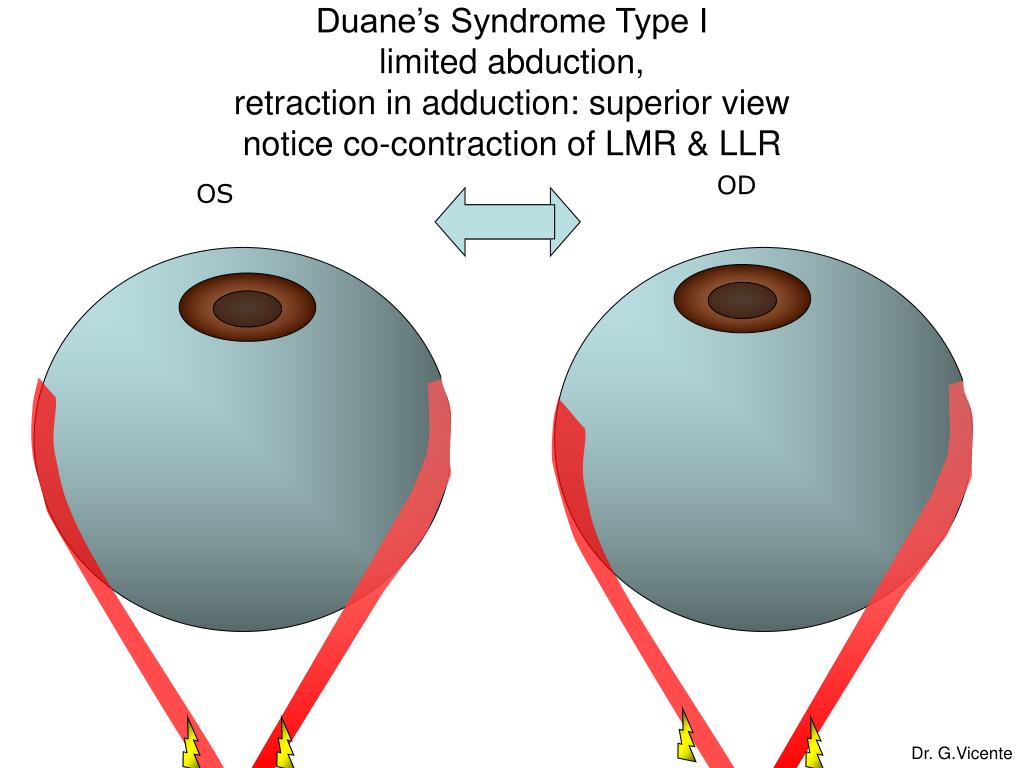 PPT Duane’s Syndrome PowerPoint Presentation, free download ID3922492