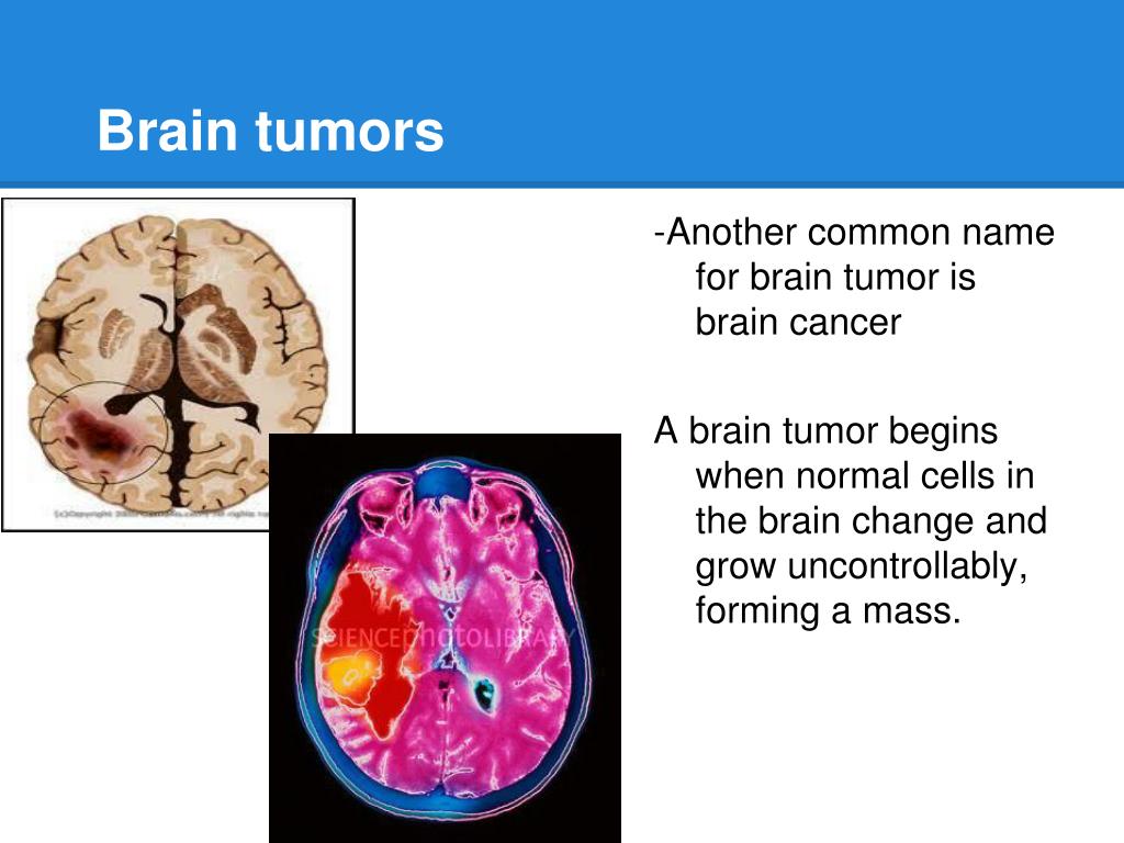 case presentation on brain tumor slideshare
