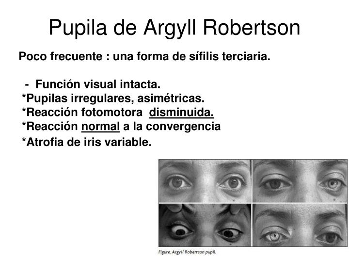 argyll robertson pupil clinical significance argyll robertson pupil clinical significance