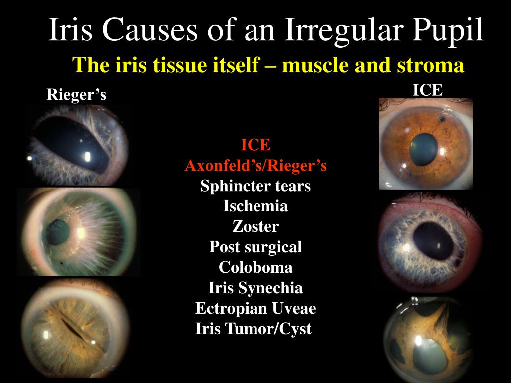 irregular pupil shape after catarct normalizes irregular pupil shape after catarct normalizes