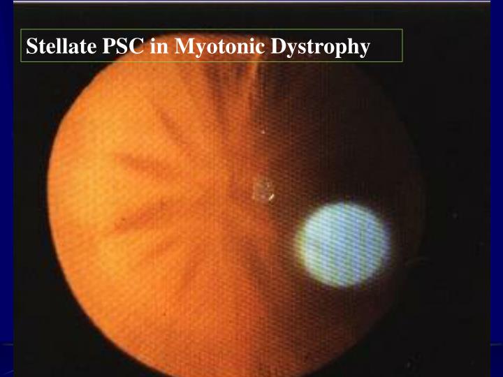 PPT Cataract PowerPoint Presentation ID3930717