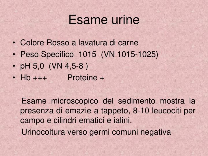 PPT - Glomerulonefriti a depositi mesangiali di IgA o ...