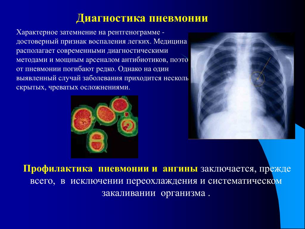 Пневмония легких осложнения. Вирусная пневмония диагноз. Диагностические критерии вирусных пневмоний. Профилактика осложнений пневмонии.