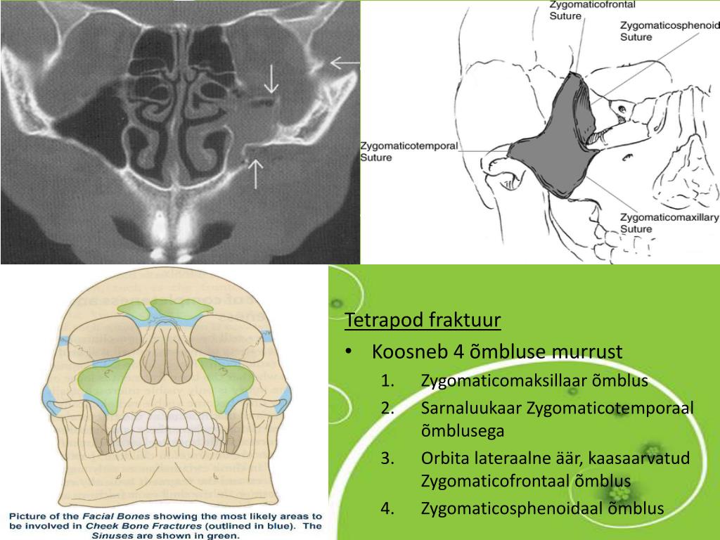 PPT - Sarnaluukeha ja –kaare murd PowerPoint Presentation, free ...