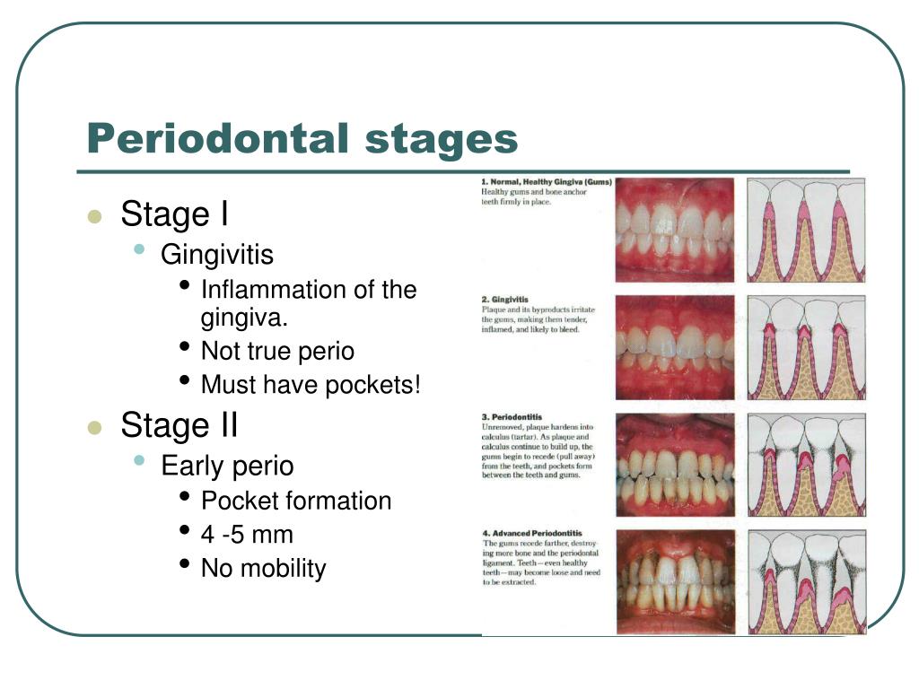 Periodontal Disease Stages
