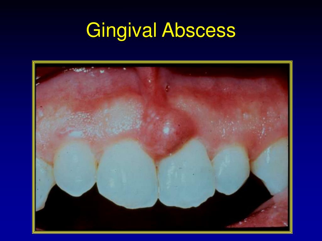 PPT ACUTE PERIODONTAL CONDITIONS PowerPoint Presentation Free 