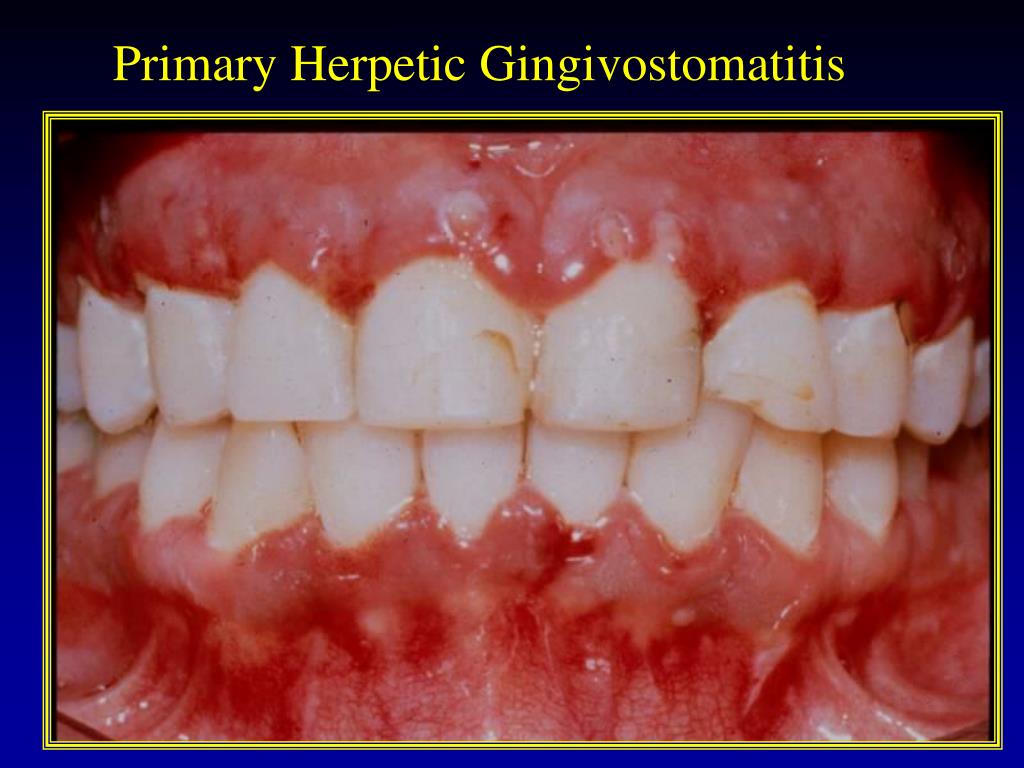 PPT ACUTE PERIODONTAL CONDITIONS PowerPoint Presentation Free 