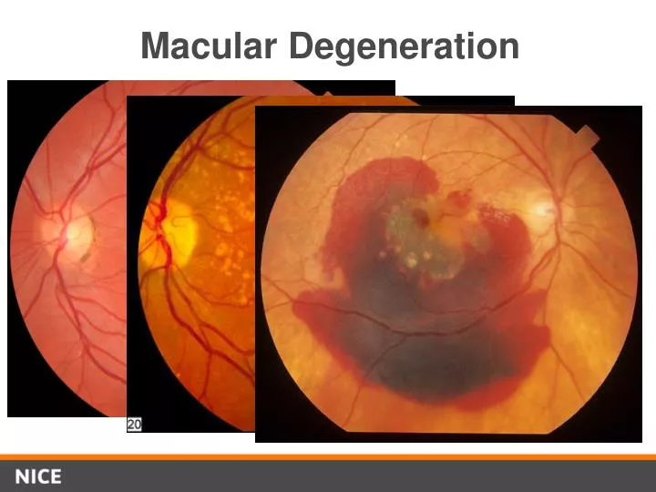 PPT Macular Degeneration PowerPoint Presentation, free download ID
