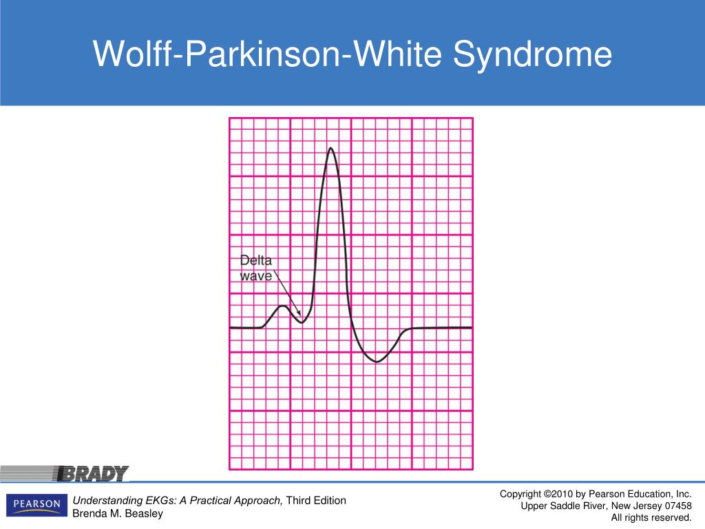 PPT - Atrial Fibrillation Rhythm PowerPoint Presentation, free download ...