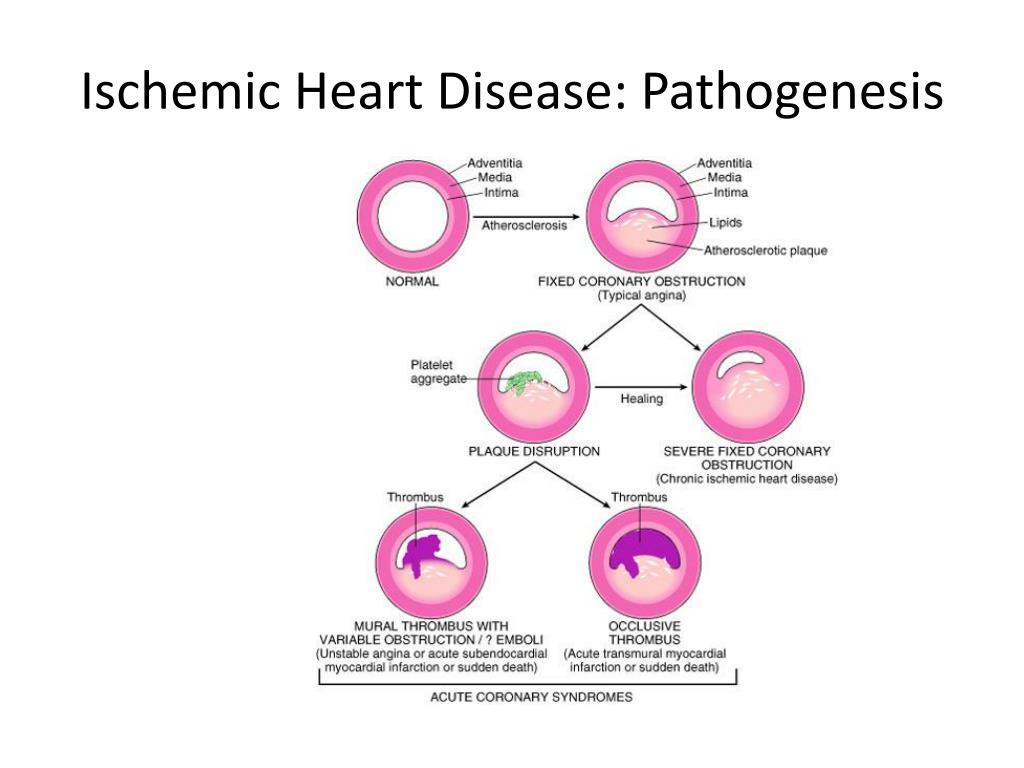 Pathophysiology Of Ischemic Heart Disease