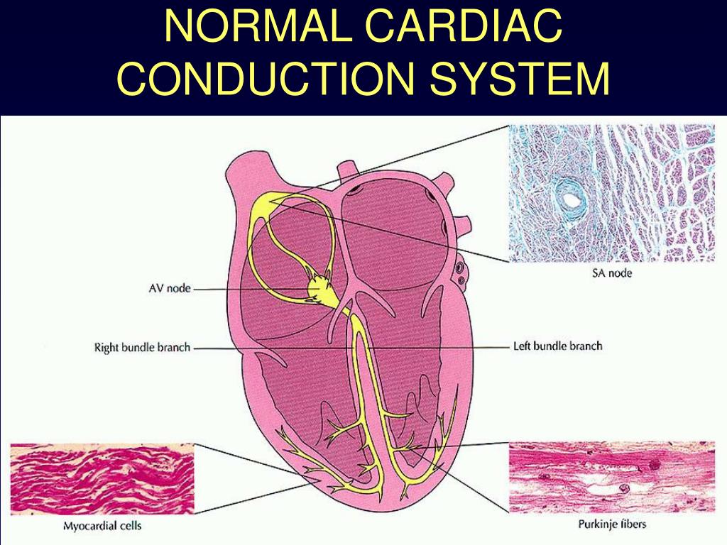 PPT CARDIAC ARRHYTHMIA PowerPoint Presentation Free Download ID 
