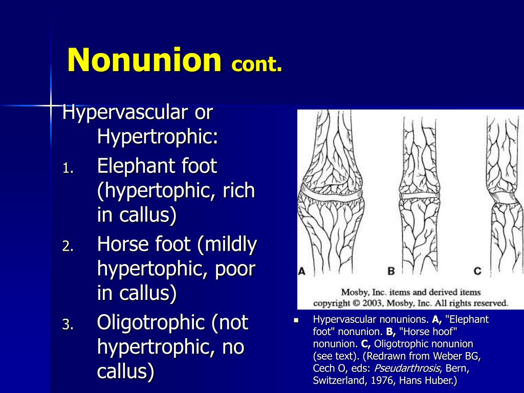 Ppt Delayed Union And Nonunion Of Fractures Powerpoint Presentation