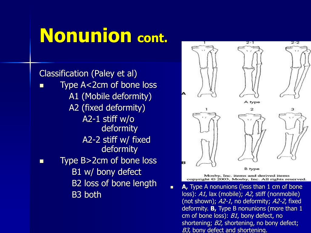 Al тип. Nonunion.