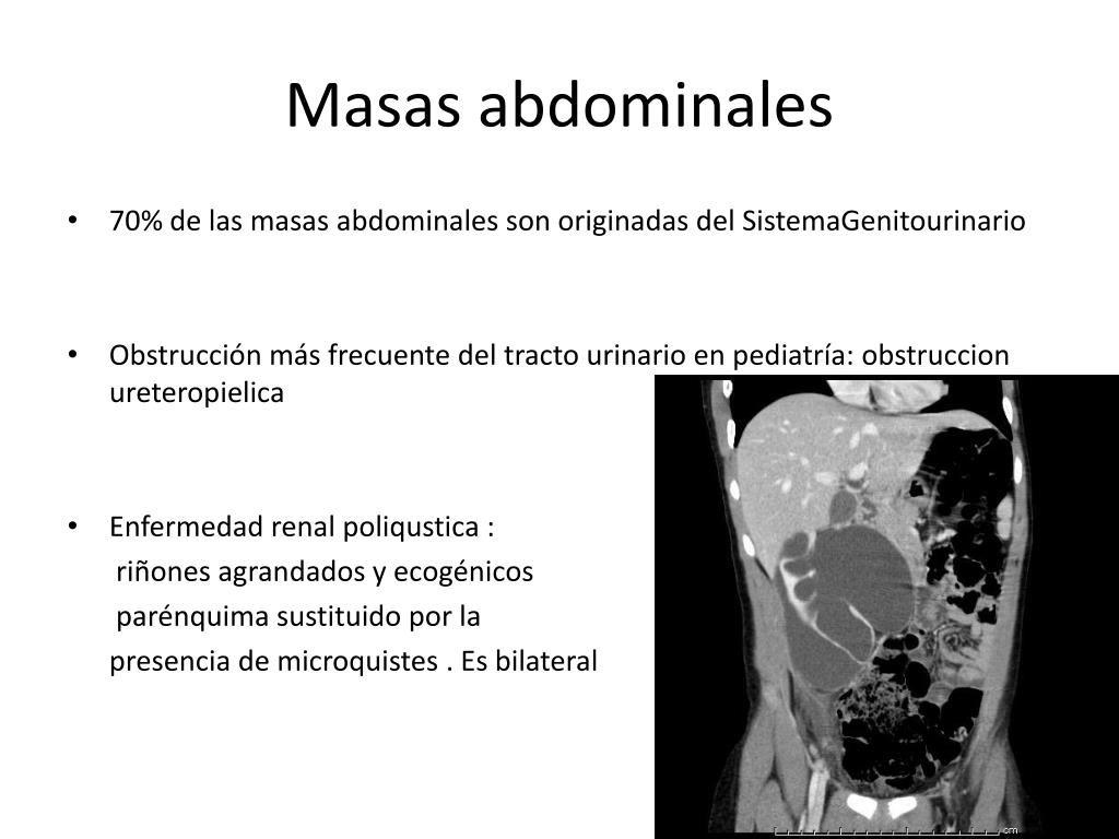 Masas Abdominales En Pediatria Download