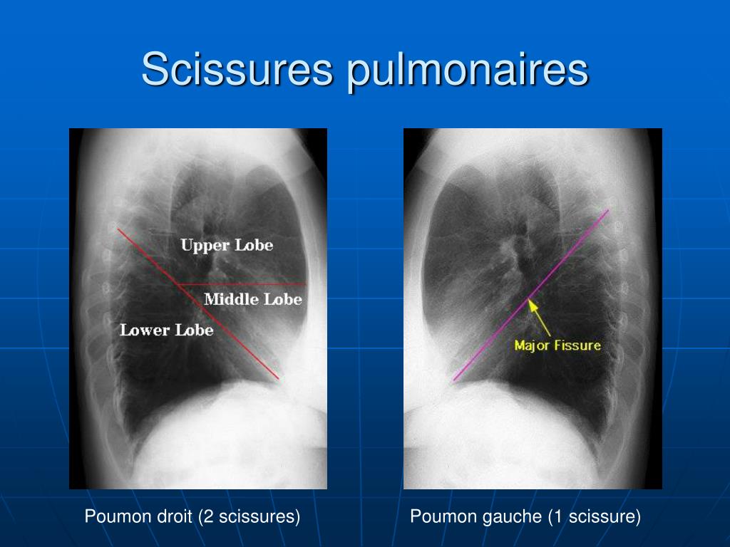 PPT - Anatomie pulmonaire PowerPoint Presentation, free download -  ID:4011744