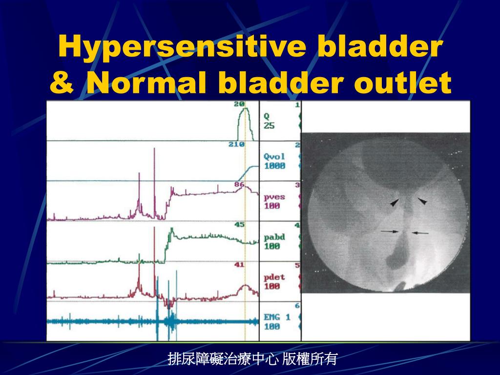 PPT - Lower Urinary Tract Symptoms in Men PowerPoint ...