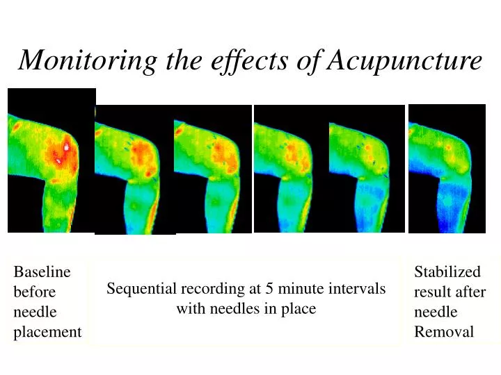 PPT Monitoring the effects of Acupuncture PowerPoint Presentation