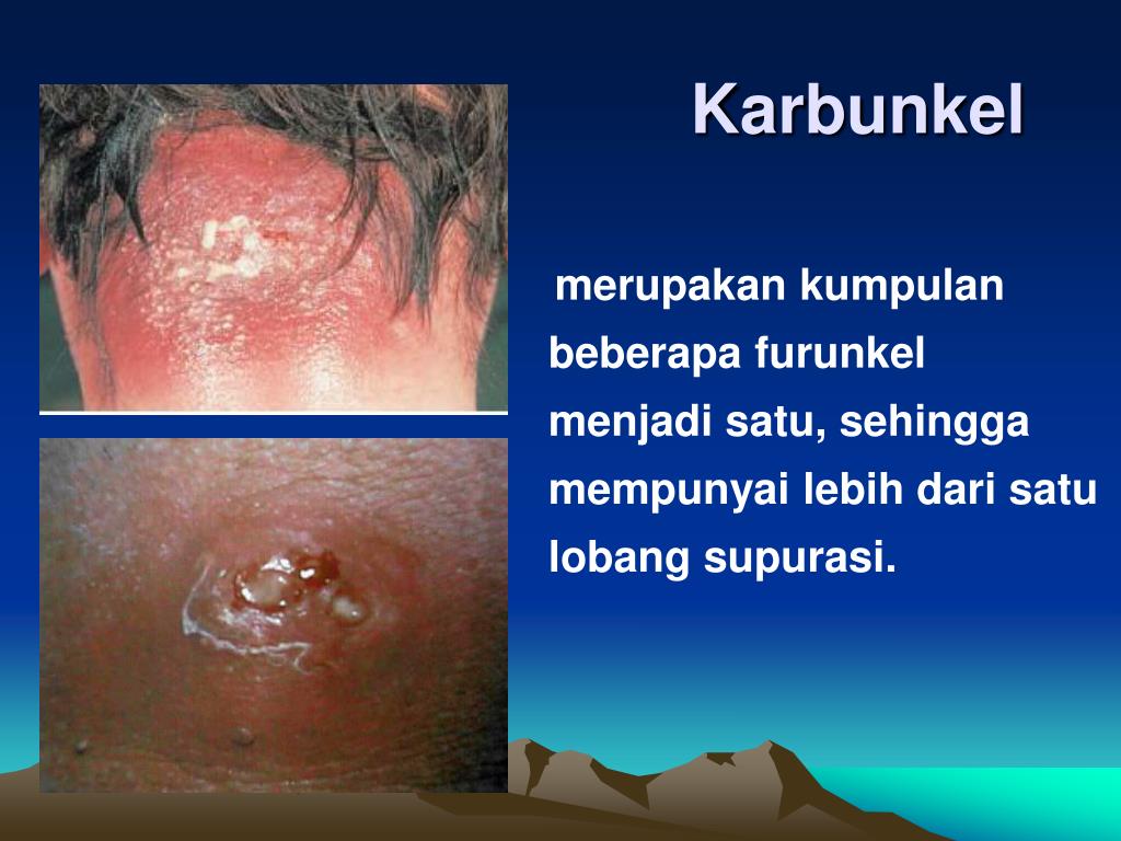 PPT - MAKULA : perubahan warna kulit semata tanpa perubahan konsistensi ...