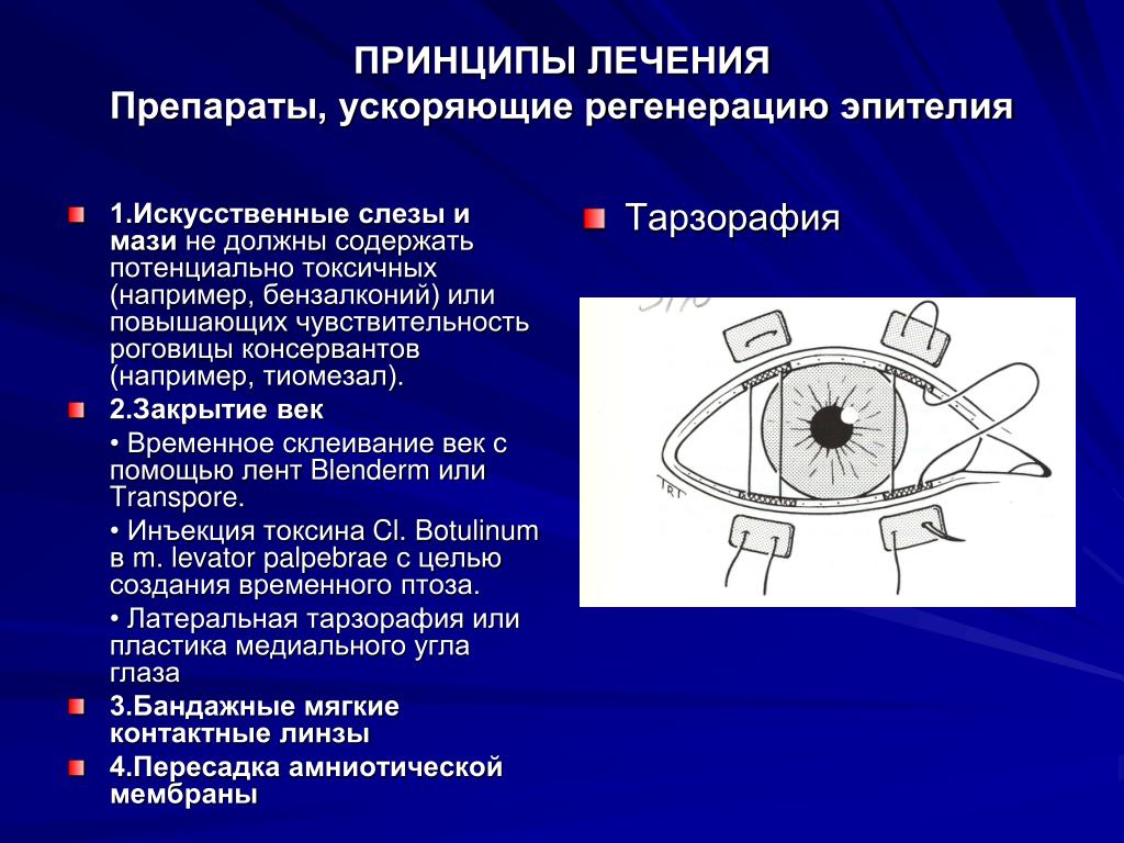 Лечение кератита