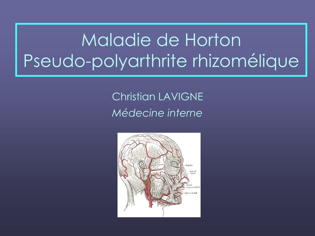 Ppt Maladie De Horton Pseudo Polyarthrite Rhizomélique Powerpoint Presentation Id 4032360
