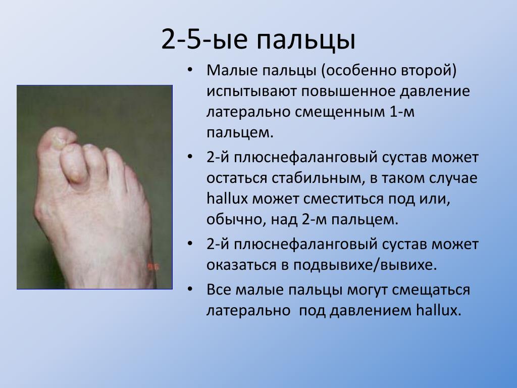 Ампутация пальцев мкб 10. Артрит плюснефалангового сустава стопы. Плюснефалангового сустава большого пальца. Плюснефалангового сустава большого пальца стопы. Плюснефаланговый сустав большого пальца ноги болит.