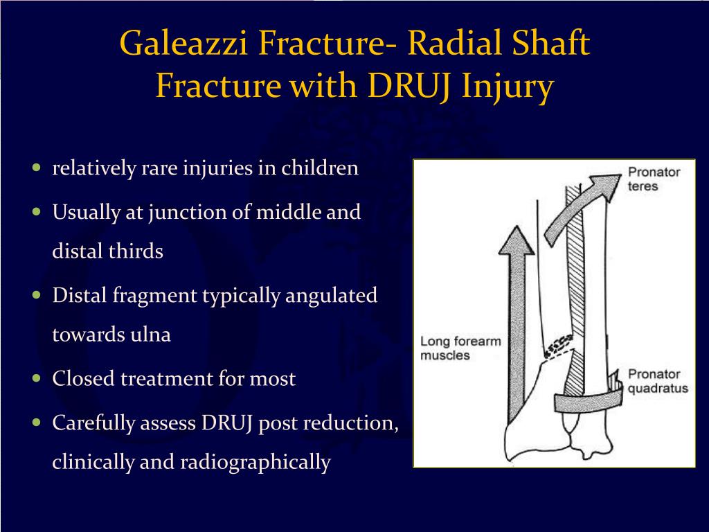therapy galeazzi fracture therapy galeazzi fracture