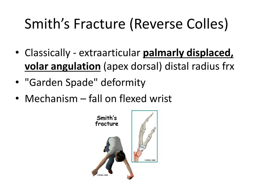 Ppt Distal Radius Fractures Powerpoint Presentation Free