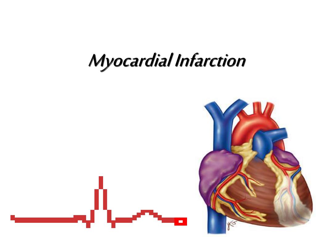 presentation of myocardial infarction