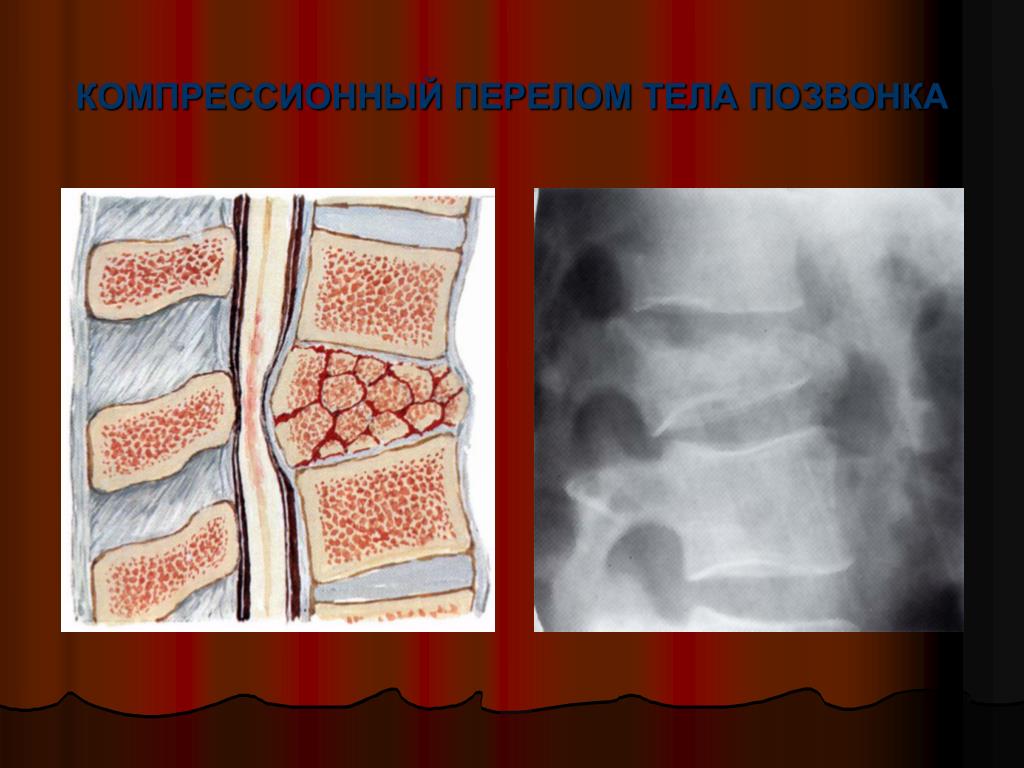 Компрессионный перелом тела 1 1. Компрессионный перелом остеопороз. Остеопороз компрессионный перелом позвоночника. Компрессионный перелом позвоночника 11 позвонка. Компрессионный перелом тела т11 позвонка.