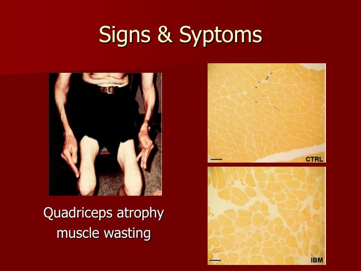 PPT Inclusion Body Myositis PowerPoint Presentation ID4073591