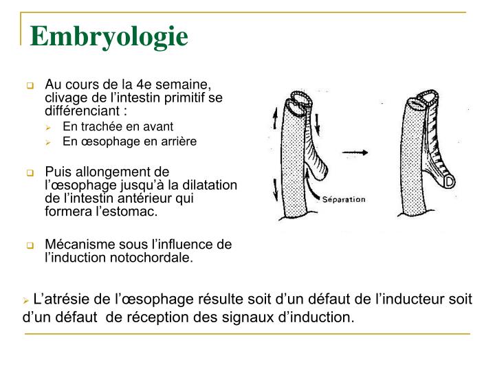 Atresie De Loesophage Esperance De Vie PPT - L’atrésie de l’œsophage PowerPoint Presentation - ID:4083979