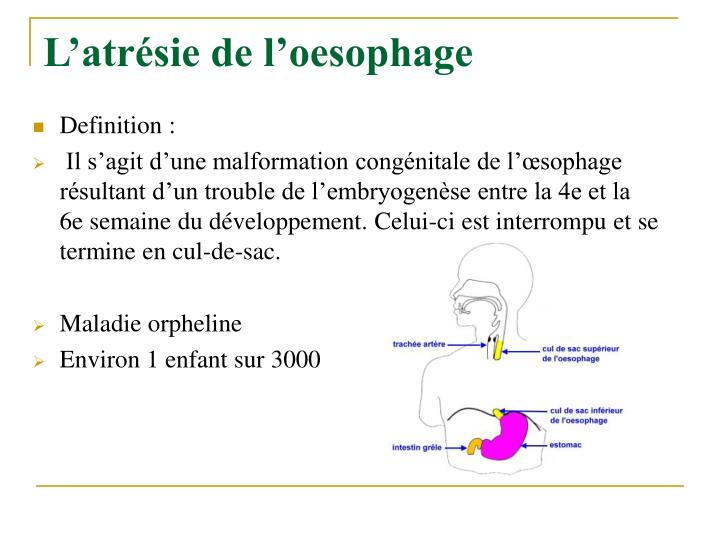 Atresie De Loesophage Esperance De Vie PPT - L’atrésie de l’œsophage PowerPoint Presentation - ID:4083979
