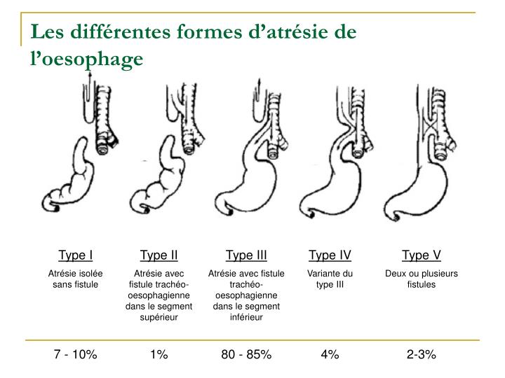 Atresie De Loesophage Esperance De Vie PPT - L’atrésie de l’œsophage PowerPoint Presentation - ID:4083979